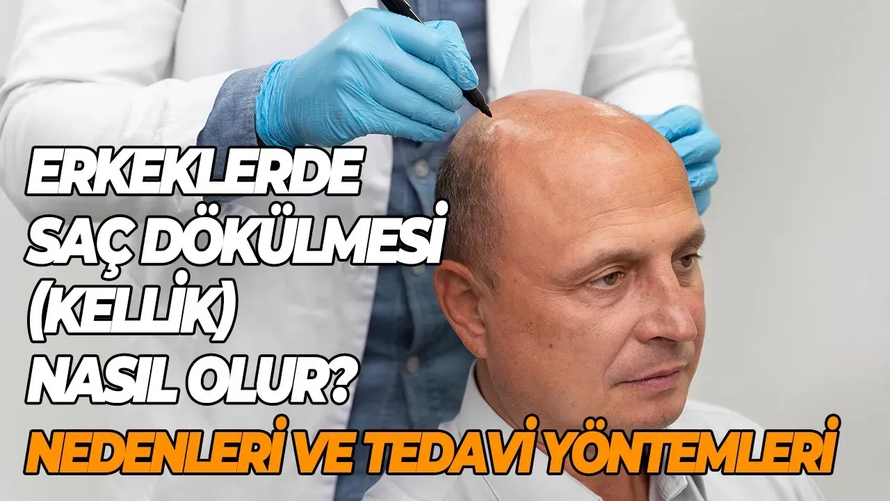 Erkeklerde saç dökülmesi(Kellik) nasıl olur? Saç dökülmesi nedenleri ve tedavi yöntemleri
