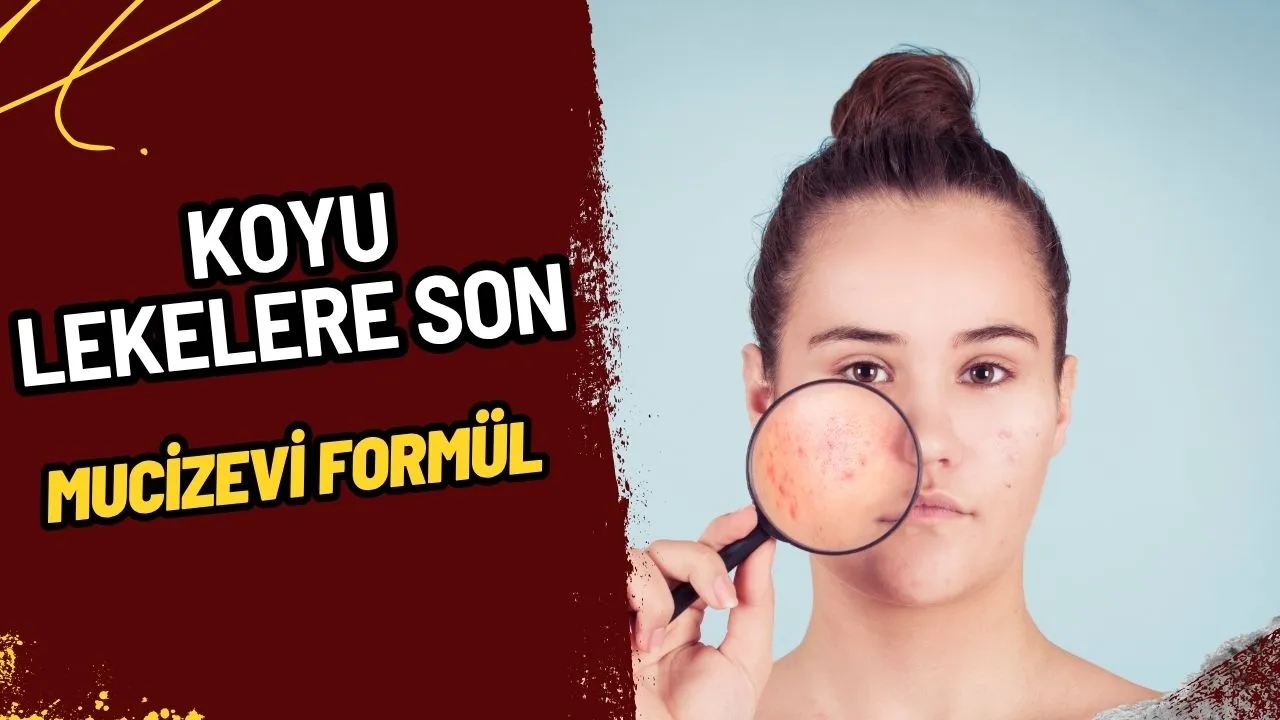 Akne Lekelerine Son! Koyu Lekelerden Kurtulmanın Etkili Yolları