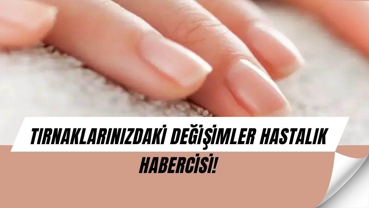 Tırnaklarınızdaki Bu Belirtiler Ciddi Hastalık Habercisi Olabilir!