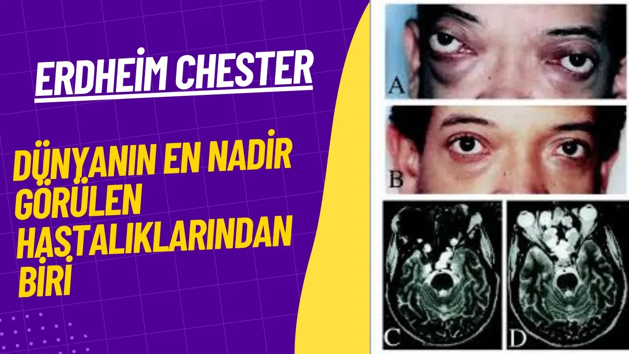 Dünyanın En Nadir Hastalıklarından Erdheim Chester