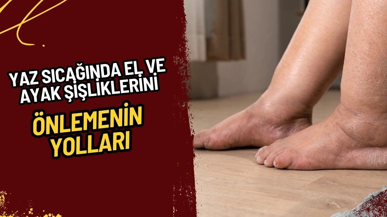 Yaz Sıcağında El ve Ayak Şişlikleri: Ödemi Engellemenin Yolları!