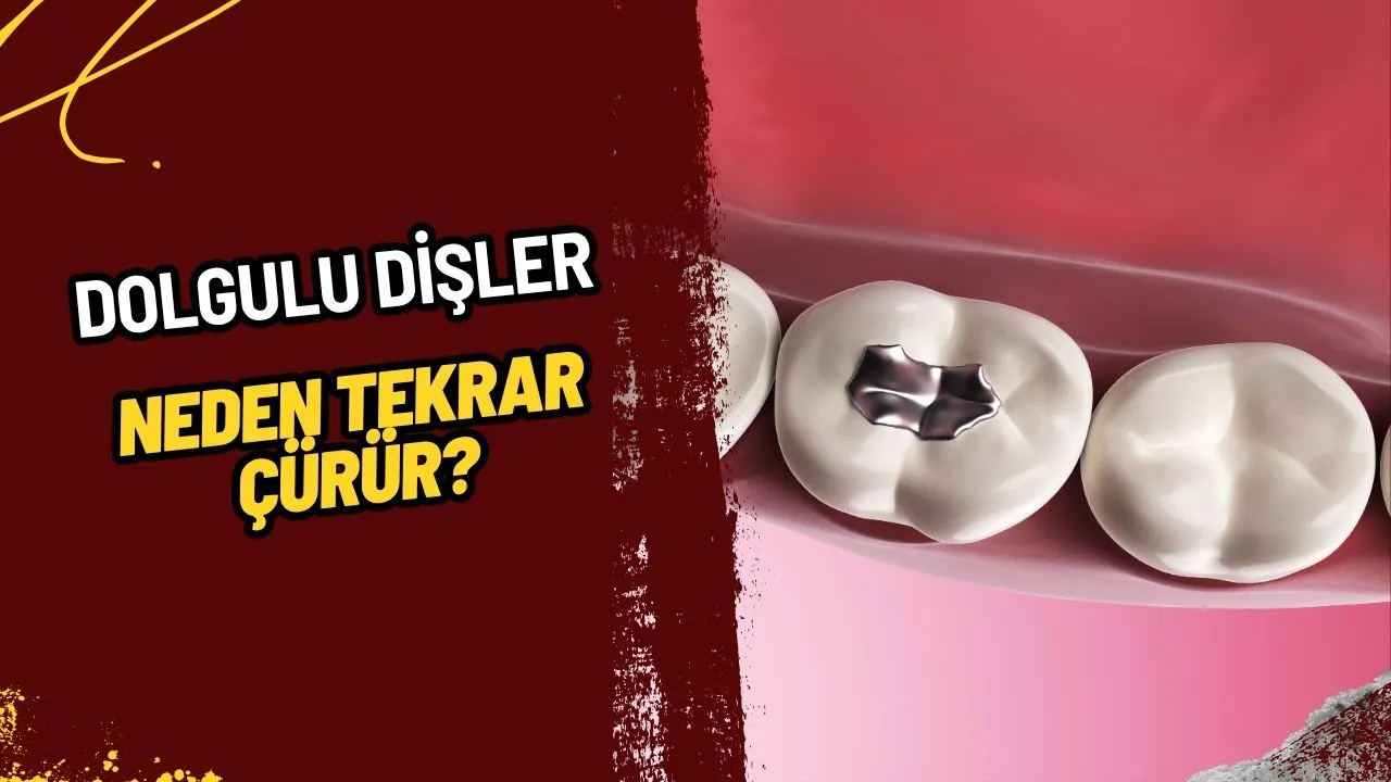 Dolgulu Dişler Neden Tekrar Çürür? Uzmanından Kritik Uyarılar!