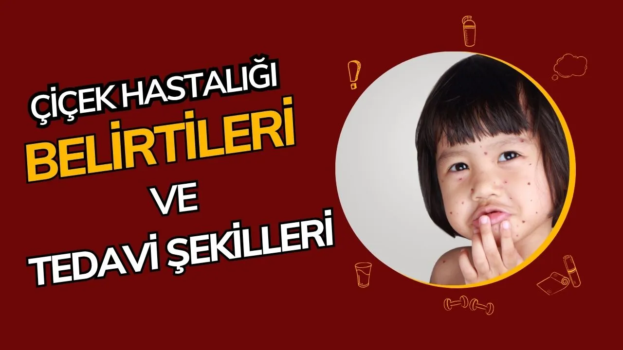 Çiçek Hastalığı Nedir? Belirtileri, Tedavisi ve Tarihi Önemi