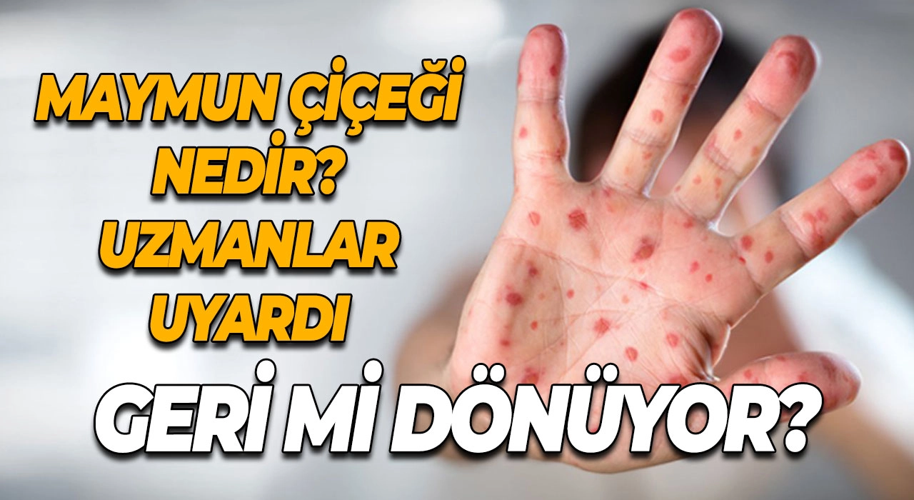 Maymun Çiçeği Geri Mi Dönüyor? Maymun Çiçeği Nedir? Uzmanlar Uyardı!